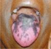 化学療法による舌の色素沈着