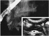 硬化性膵炎患者における血清 IgG4 濃度の上昇