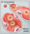 医学の進歩：髄膜炎菌疾患