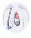 末期心不全における左心補助装置