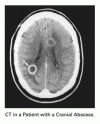 髄膜炎の疑い症例に対する CT と腰椎穿刺