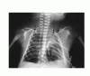 Images in Clinical Medicine：肺低形成の新生児における広範囲空気塞栓症
