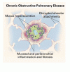 Clinical Practice：慢性閉塞性肺疾患の急性増悪