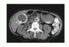 Images in Clinical Medicine（Web 限定）：陶器様胆嚢