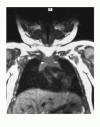 生体外遺伝子治療による X 染色体連鎖重症複合免疫不全症の継続的な回復