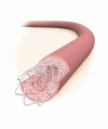 バイパス移植片でのステント内再狭窄に対する血管内照射