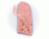 医学の進歩：気管支拡張症