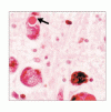 疾患のメカニズム：α<sub>1</sub> アンチトリプシン欠損症 ― 蛋白の構造変化による疾患モデル