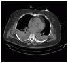 Clinical Practice：胸水