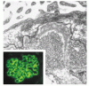 短報：抗中性エンドペプチダーゼ抗体による出生前の膜性糸球体腎炎