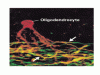 多発性硬化症慢性病変におけるオリゴデンドロサイト