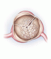 Clinical Practice：大動脈狭窄