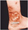 壊疽性膿皮症と誤診された皮膚潰瘍