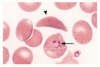 Images in Clinical Medicine（Web のみ）：マラリアと鎌状赤血球症