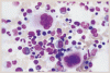 免疫性血小板減少性紫斑病に対する高用量デキサメタゾン