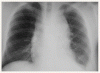 進行性リンパ腫に対する大量化学療法と幹細胞支持療法