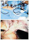 結腸癌に対する腹腔鏡補助下切除術と開腹切除術の比較