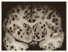 脳嚢虫症に対する抗寄生虫薬治療