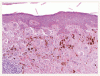 多数の色素性病変を有し黒色腫の既往がある女性