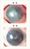 自己口腔粘膜上皮による角膜再生