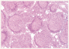 濾胞性リンパ腫における腫瘍浸潤性の免疫細胞と生存期間