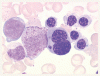 骨髄異形成症候群に対するレナリドミド