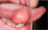 舌の脂肪腫