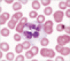 ブドウ状の白血球核