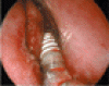 篩骨洞における歯科インプラント