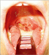 耳下腺腫瘍による扁桃の非対称性
