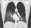 巨大気腫性囊胞症候群