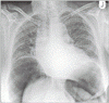 気腹症における肝臓の回転