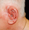 耳介腫脹
