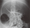 急性偽性結腸閉塞症