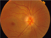 網膜の検査