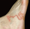 皮膚爬行症：皮膚幼虫移行症
