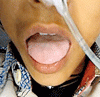 有機リン中毒における舌の筋線維束性攣縮
