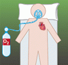 心筋梗塞が疑われる患者に対する酸素療法の転帰