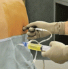 胸腔カテーテル留置のための超音波ガイド