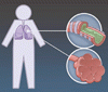 COPD 増悪を減少させる