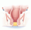 直腸診と肛門鏡検査