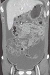 結核性腹膜炎