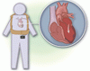 心筋梗塞後の高リスク期間における装着型自動除細動器