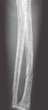 副甲状腺癌による橈骨骨折