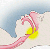 成人における閉塞性睡眠時無呼吸