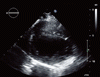 経胸壁心エコー検査