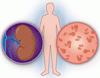 慢性腎臓病における貧血を治療する