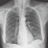 肺癌を有し胸痛を訴える女性