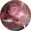 胸部パラガングリオーマの内視鏡的切除