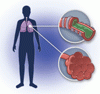 COPD の増悪を抑制する